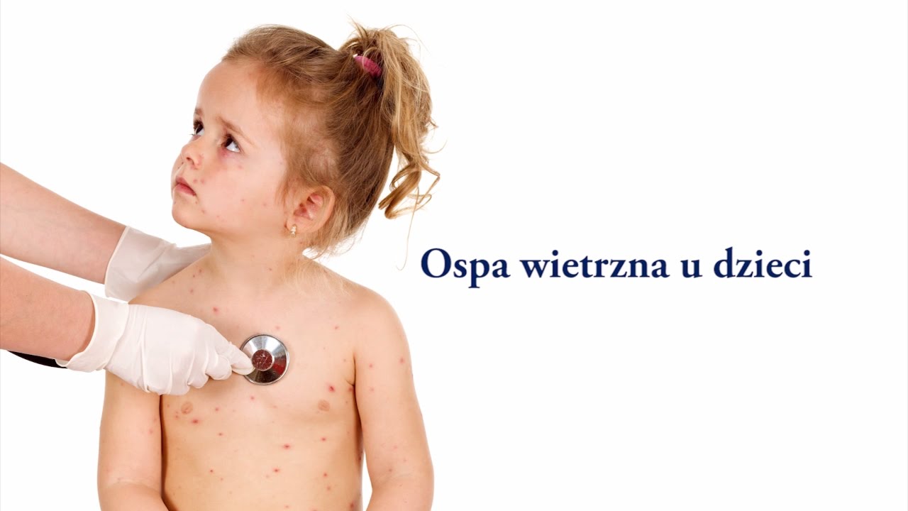 Ospa Wietrzna Jak Ulżyć Dziecku