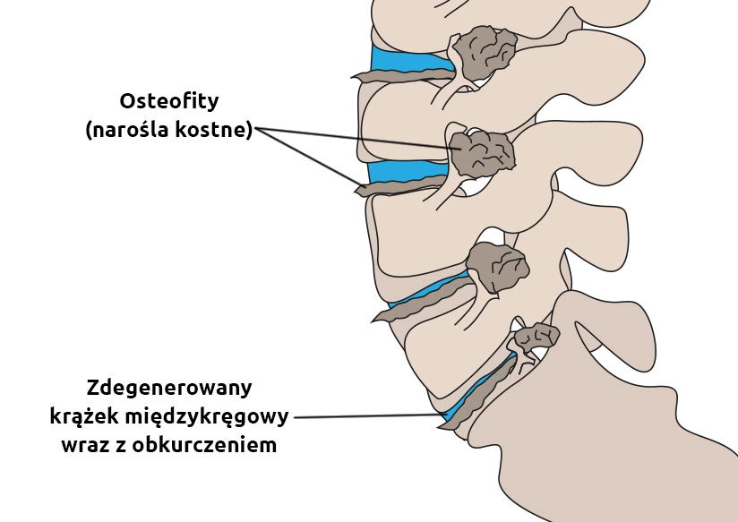 Osteofity | Mama ocenia, testuje, poleca Podstawami Dwóch Ostrosłupów Są Takie Same Wielokąty