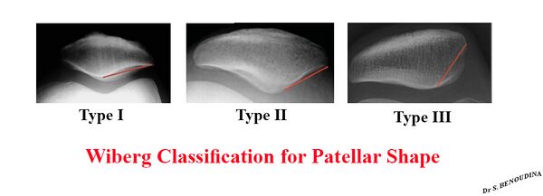 Patella — Wikimedica Rzepka Typu Iii Wg Wiberga