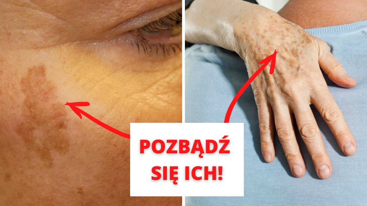 Plamy starcze na twarzy możesz usunąć domowymi sposobami - Zobacz JAK Czerwone Plamy Na Wewnętrznej Stronie łokcia
