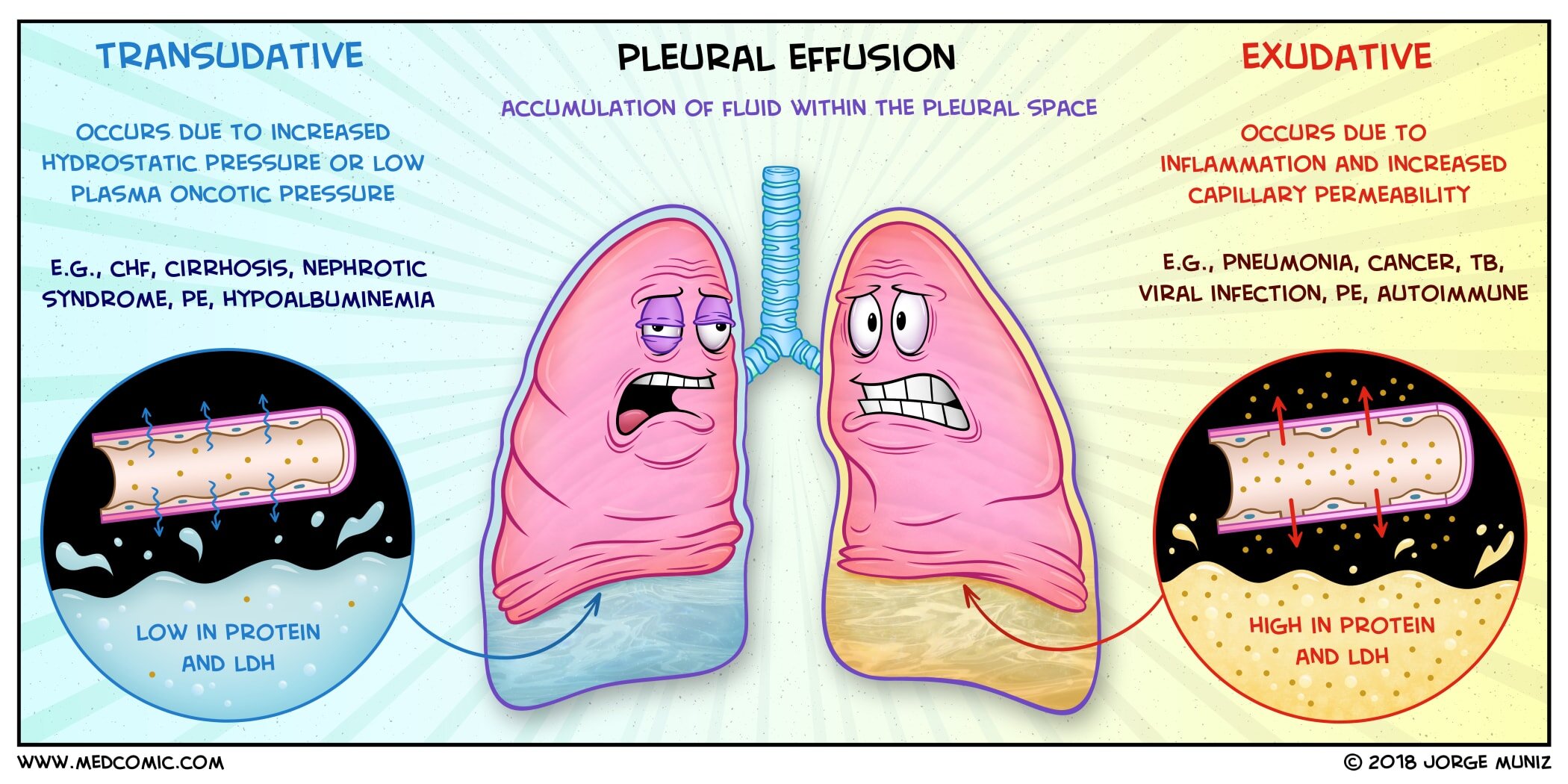 Exudative Vs Transudative Pleural Effusion Mnemonic