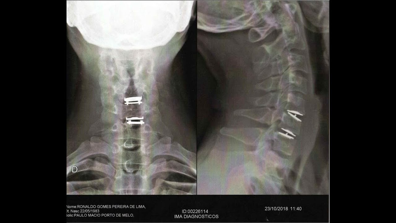 PÓS OPERATÓRIO DE HÉRNIA DE DISCO CERVICAL C4- C5-C6-C7 - YouTube Posługując Się Podkreśleniami Liniami Ramkami Zaznacz W Tekstach Biblijnych