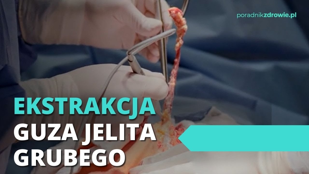 PRAWDZIWA OPERACJA. WYCIĘCIE RAKA JELITA GRUBEGO | Skalpel - YouTube Jak Długo Boli Po Operacji Jelita Grubego