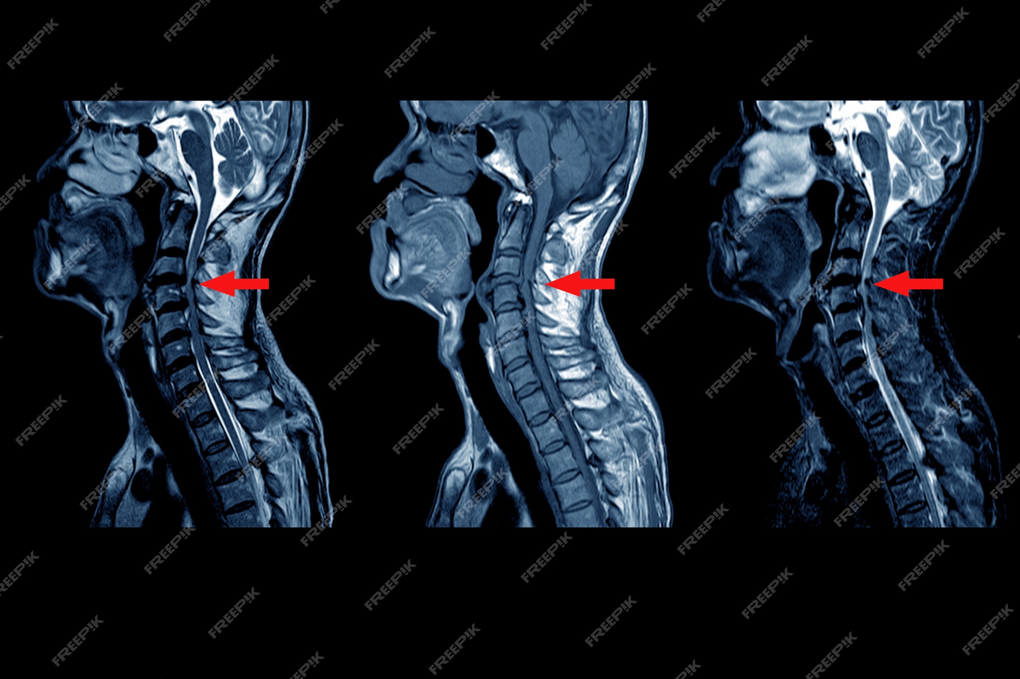 Premium Photo | Mri of cervical spine : moderate to severe posterior Mnożenie Ułamków Dziesiętnych W Słupku
