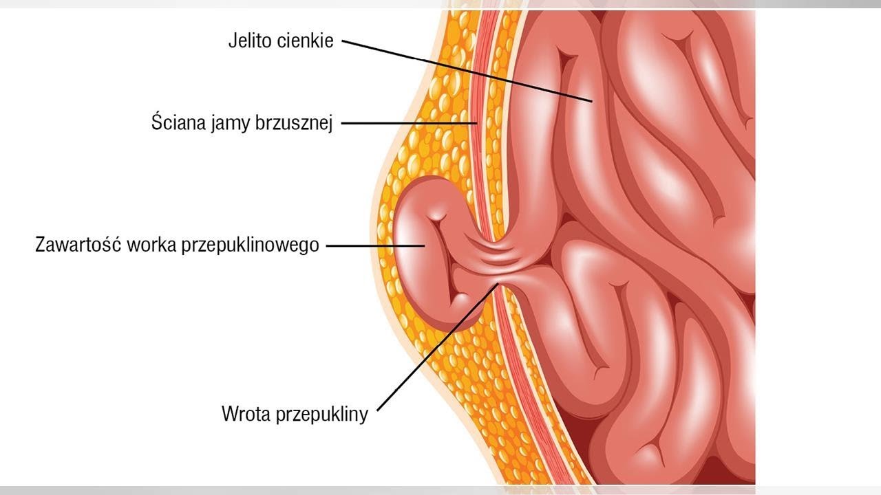 Wgłobienie Jelita U Dziecka Objawy