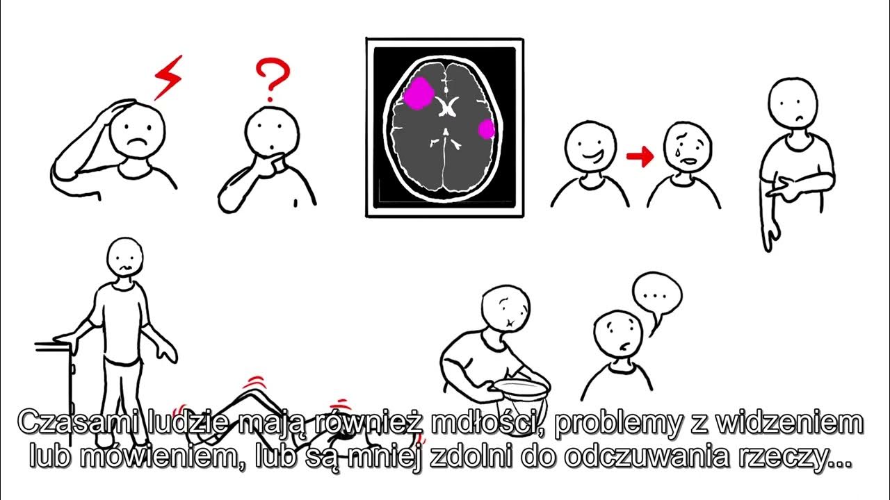 Zapalenie Pluc Po Udarze Rokowania