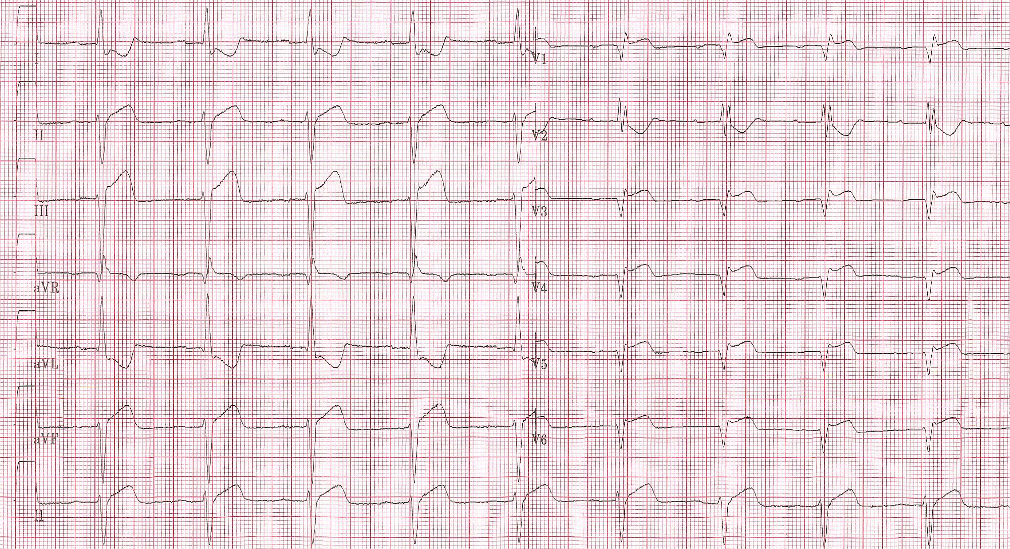 Blok Prawej Odnogi Peczka Hisa Ekg