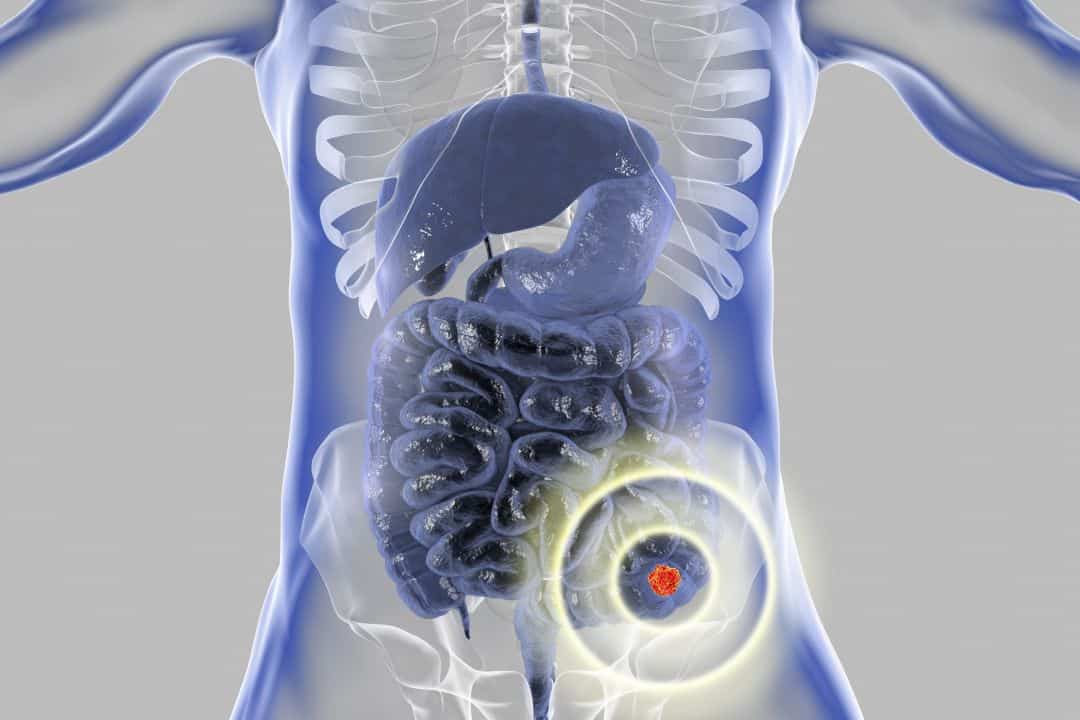Rak jelita grubego - kompendium wiedzy - coloncancer.pl Koszty Leczenia Raka Jelita Grubego