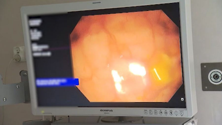 Jak Długo Boli Po Operacji Jelita Grubego