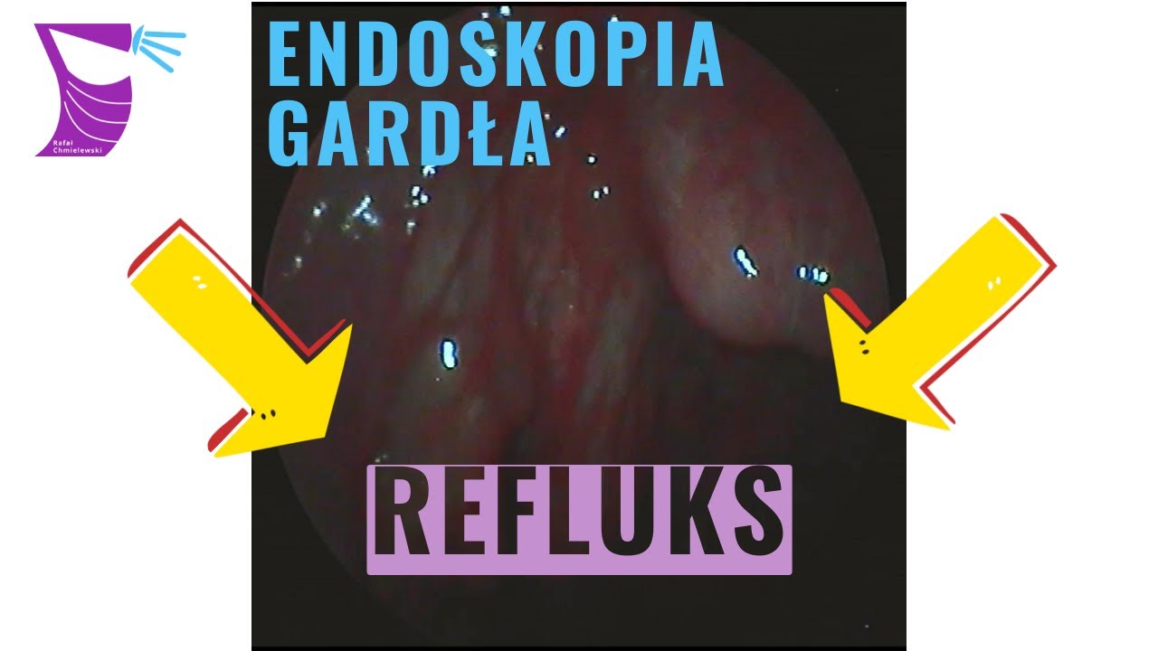 Refluks Krtaniowo Gardłowy Objawy Leczenie