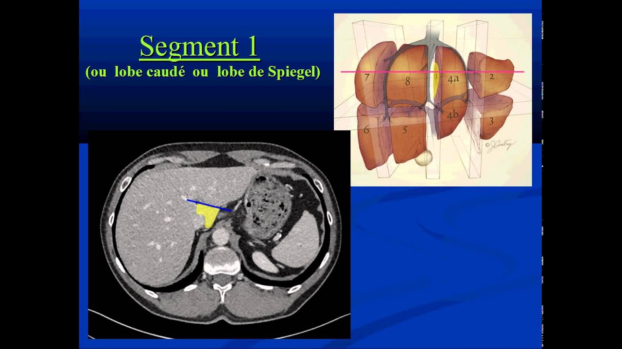 Foie Dysmorphique Avec Hypertrophie Du Segment 1