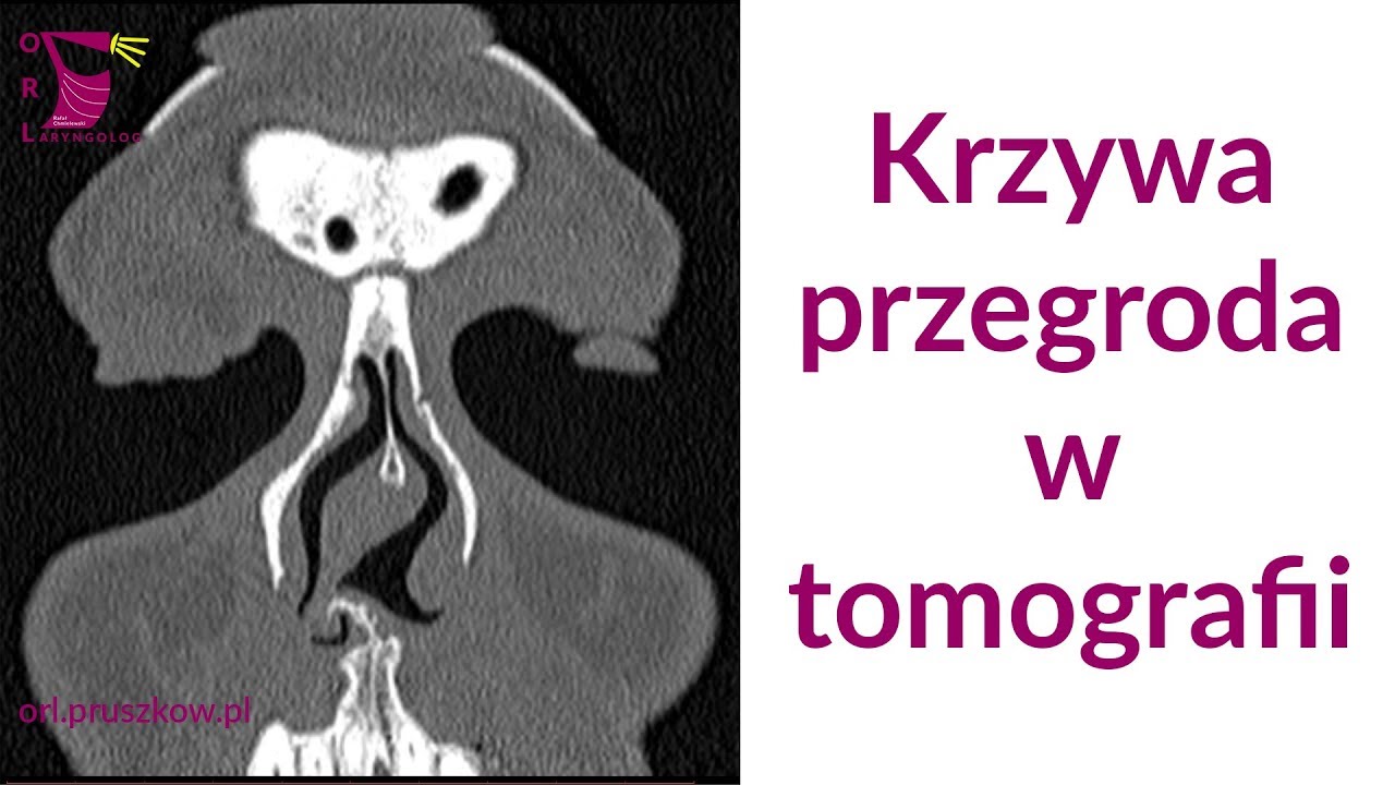 Skrzywienie przegrody nosa w tomografii komputerowej - YouTube Choroby Nosa I Zatok Przynosowych Krzeski