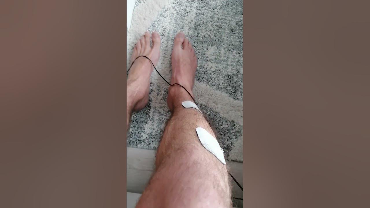 stymulacja nerwu strzałkowego - YouTube Elektrostymulacja Nerwu Strzalkowego Ulozenie Elektrod