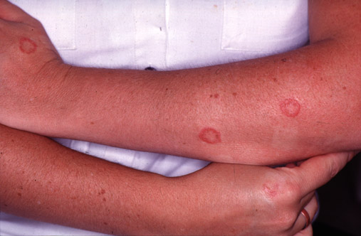 Superficial Fungal Infection Microsporum Canis U Ludzi Leczenie