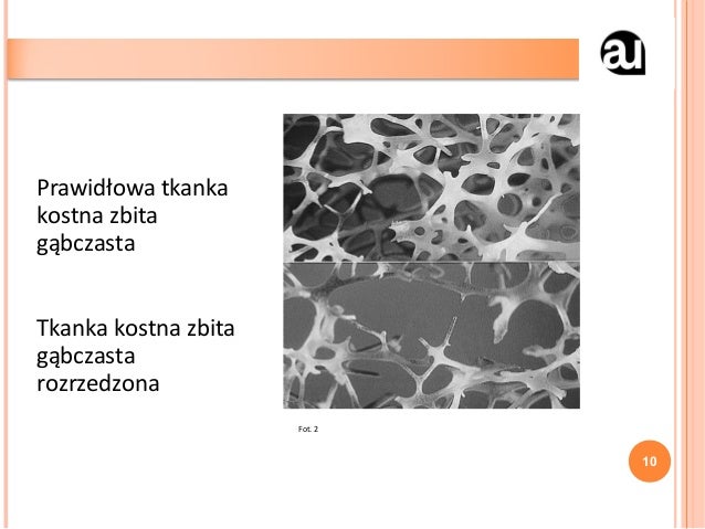 Torbielowate Rozrzedzenie Tkanki Kostnej Choroby