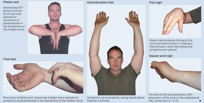 Treatment for Carpal tunnel syndrome ~ akufisio.blogspot Togheter Tests