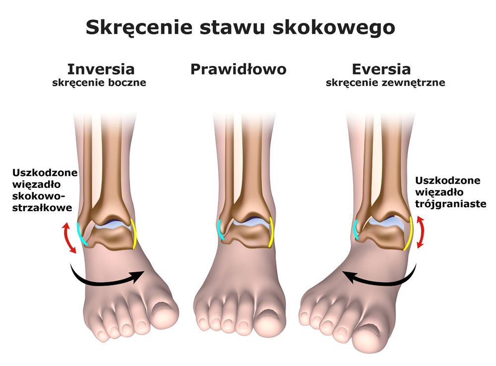 Uraz Skretny Stawu Skokowego Odszkodowanie