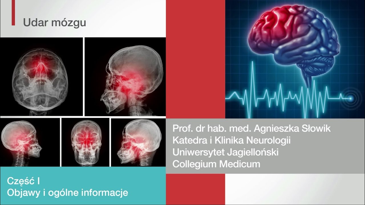 Udar Niedokrwienny Pnia Mózgu Rokowania