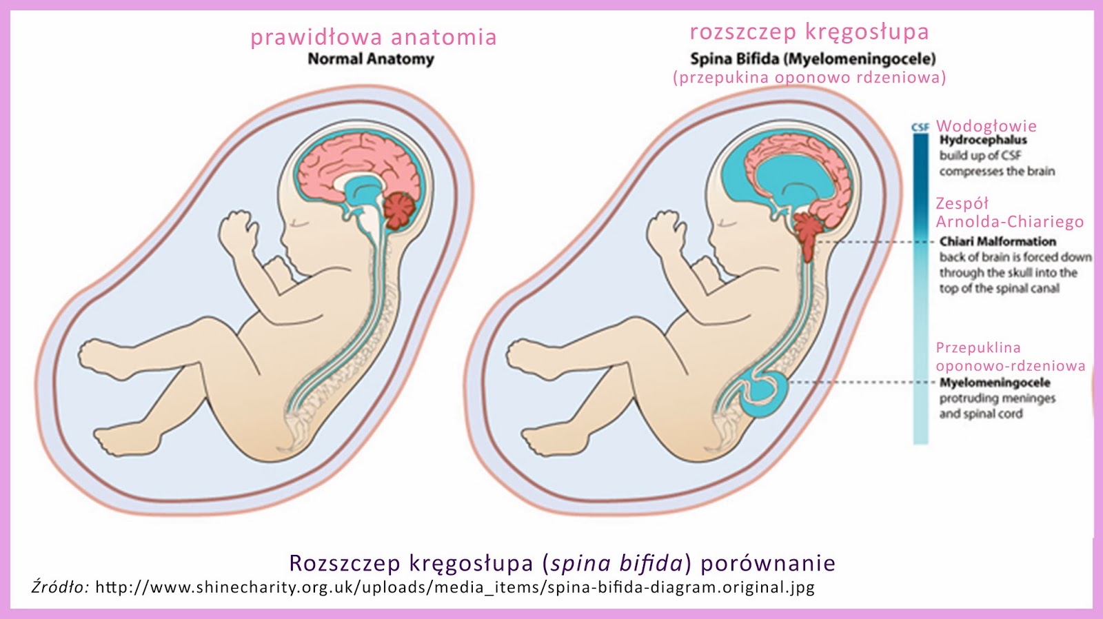 Uśmiech Paulinki Rozszczep Podniebienia Miekkiego U Noworodka