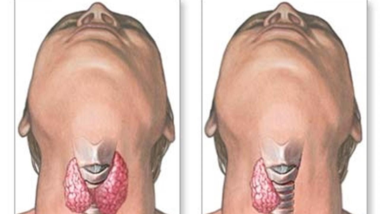 Operacja Tarczycy Z Neuromonitoringiem Cena