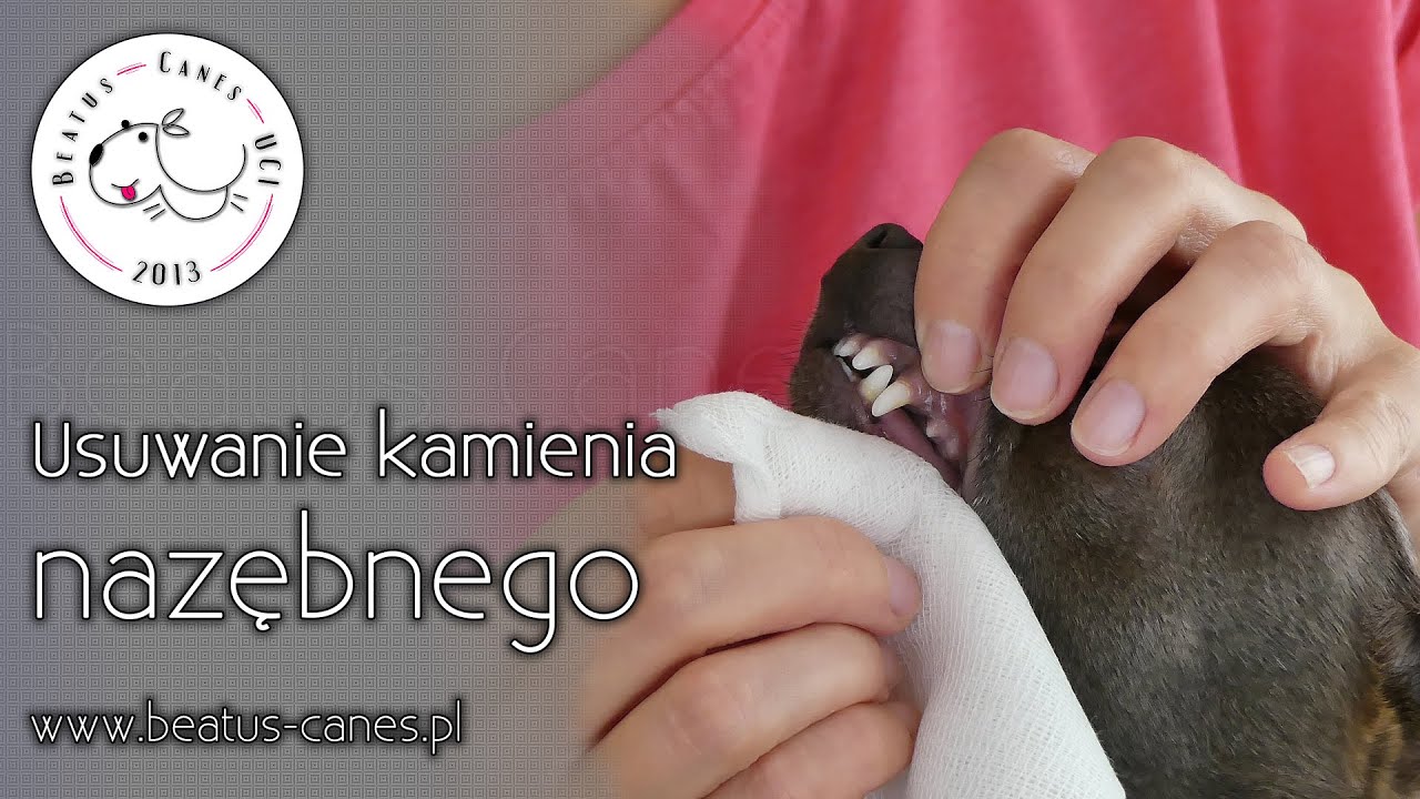 Zabieg Usunięcia Kamienia Ze ślinianki