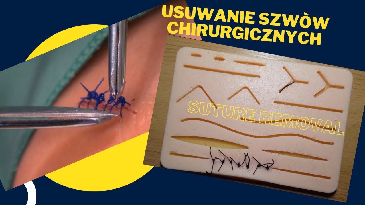 Usuwanie szwow chirurgicznych. Suture removal, Basic training. - YouTube Rekonwalescencja Po Operacji Guza Mózgu