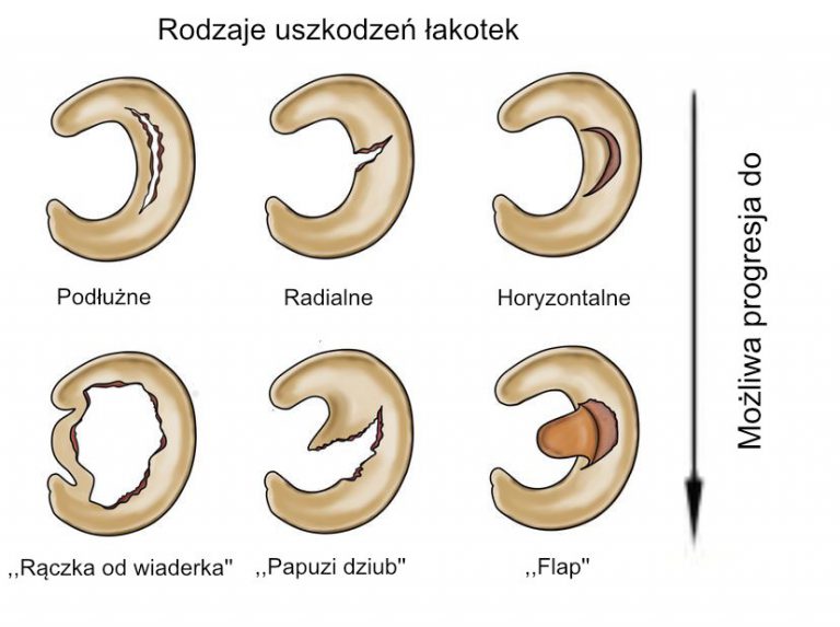 Uszkodzenie Lakotki Przysrodkowej Typu Raczki Od Wiadra