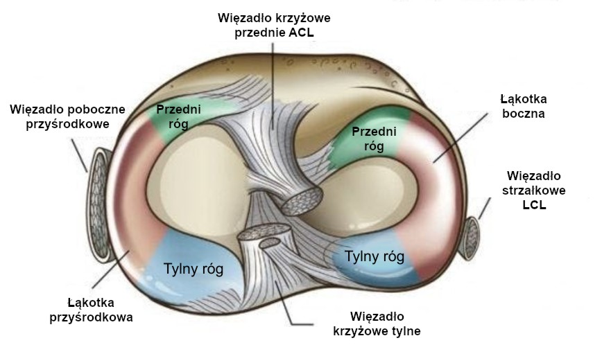 Uszkodzenie łąkotki przyśrodkowej rogu tylnego | Chirurgia Kolana Uszkodzenie Lakotki Przysrodkowej Typu Raczki Od Wiadra