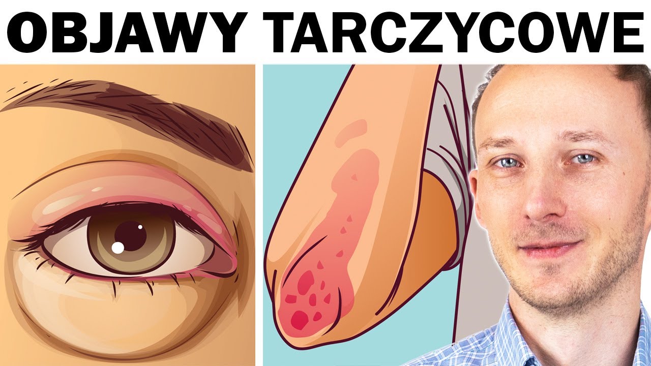Wczesne i późniejsze objawy chorej tarczycy. Masz je? Zrób te badania W Pewnym Trójkącie Równoramiennym Kąt Przy Podstawie Jest O 30