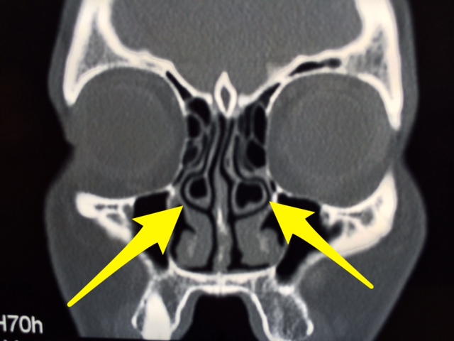 What is a Concha Bullosa? - Isaac Namdar, MD Concha Bullosa Malzowiny Nosowej Srodkowej