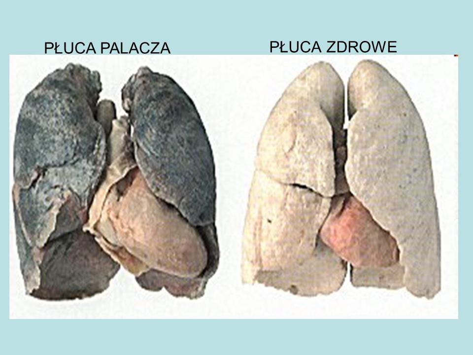 Pluca Palacza Vs Zdrowe Pluca