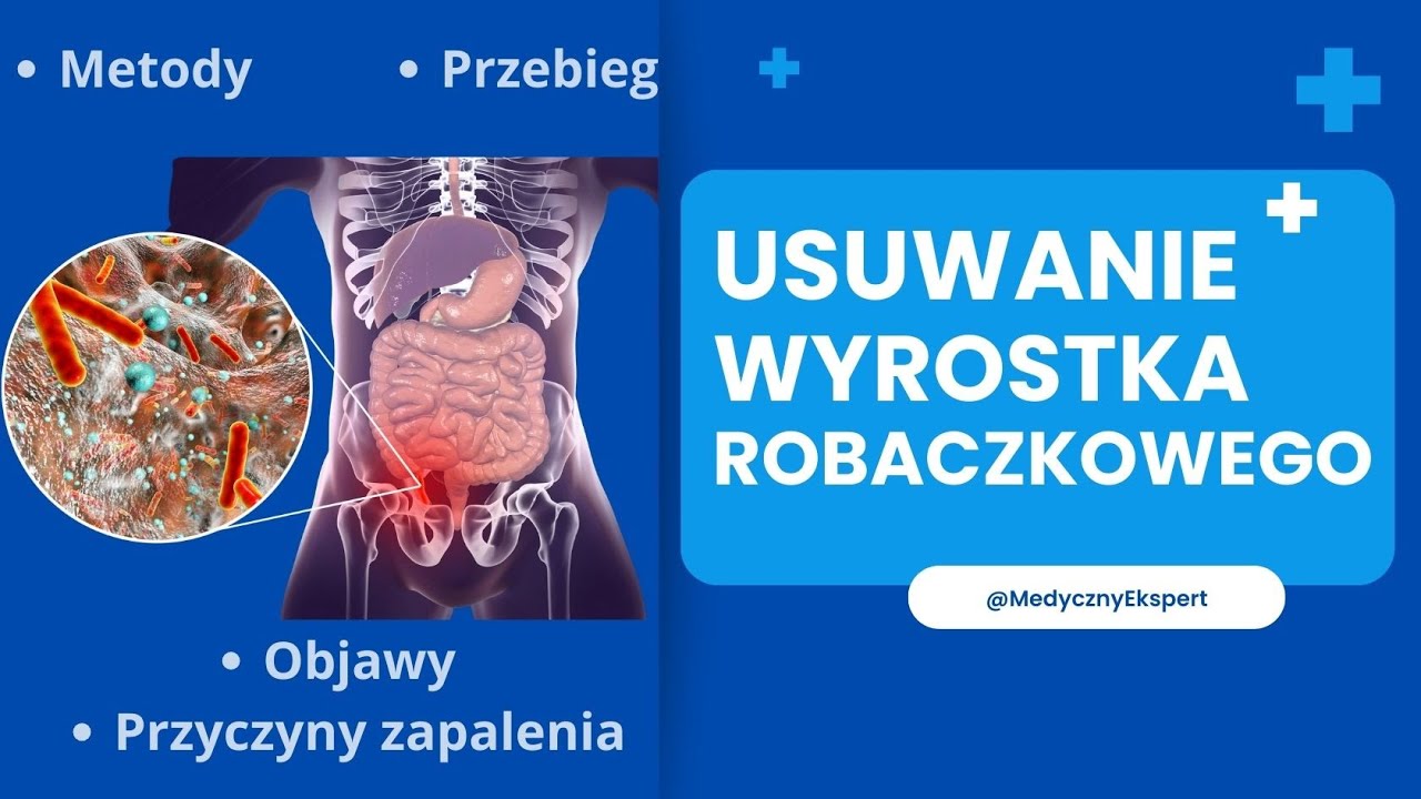 Wycięcie wyrostka robaczkowego: Diagnoza, Objawy i Leczenie - YouTube Wyrostek Rylcowaty W Gardle Objawy