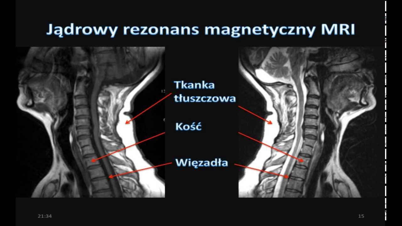 Zmiany Naczyniopochodne W Mózgu Leczenie
