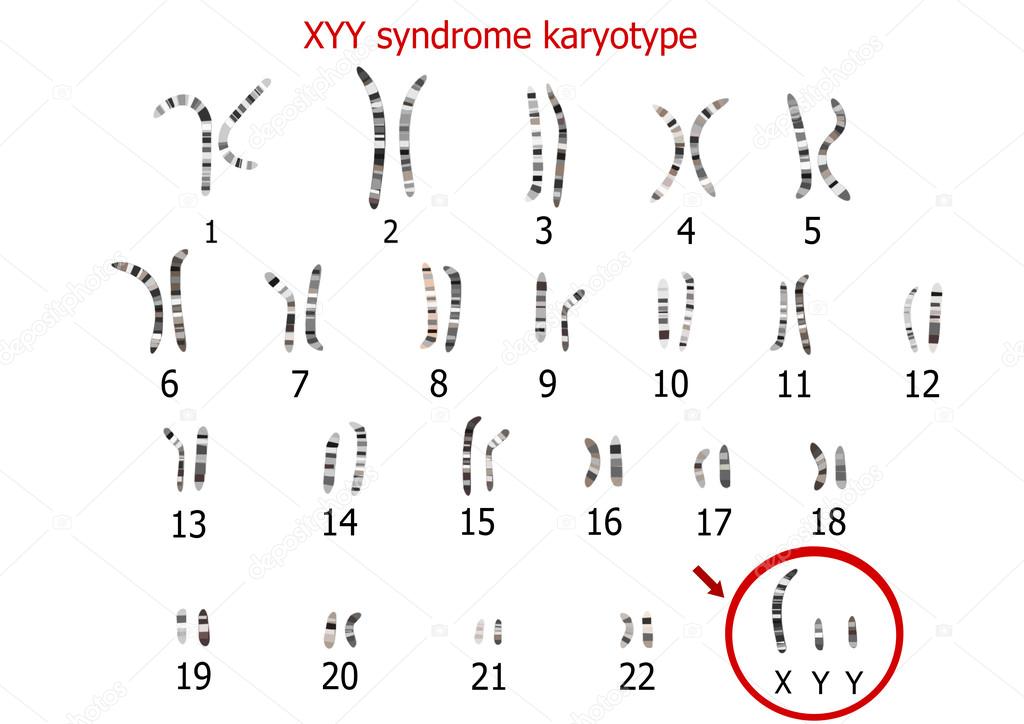 XYY syndrome (supermale) karyotype ⬇ Vector Image by © zuzanaa | Vector Pierwsze Narzędzie Człowieka Z Kamienia