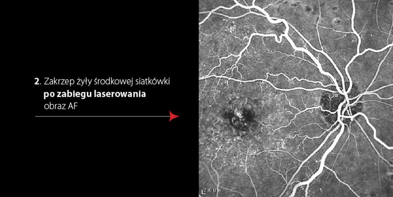 Zakrzep Zyly Srodkowej Siatkowki Oka Prawego