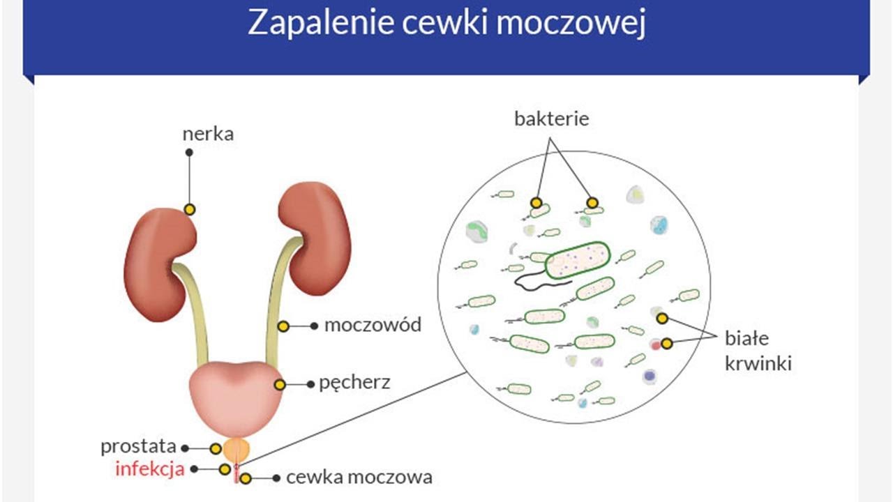 Zapalenie cewki moczowej - YouTube Niebakteryjne Zapalenie Cewki Moczowej U Mężczyzn