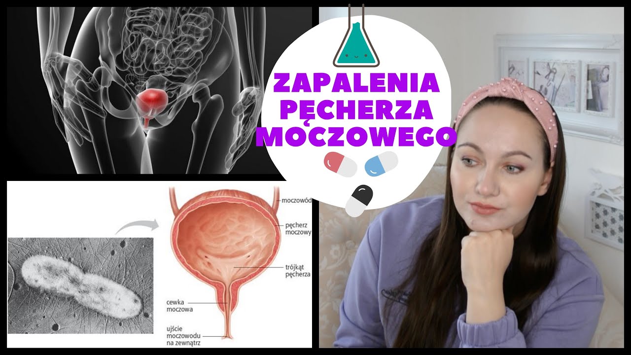 ZAPALENIE PĘCHERZA MOCZOWEGO| Nawracające co kilka miesięcy - YouTube Ostre Cewkowo Srodmiazszowe Zapalenie Nerek