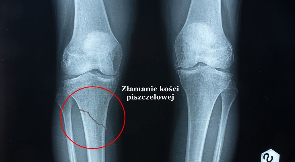 Złamanie kości łódeczkowatej – leczenie, operacja, rehabilitacja Zlamanie Klykcia Bocznego Kosci Piszczelowej Orteza