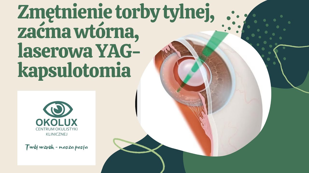 Zmętnienie torby tylnej, zaćma wtórna, YAG kapsulotomia - YouTube Zespół Rzekomego Złuszczania Torebki Soczewki