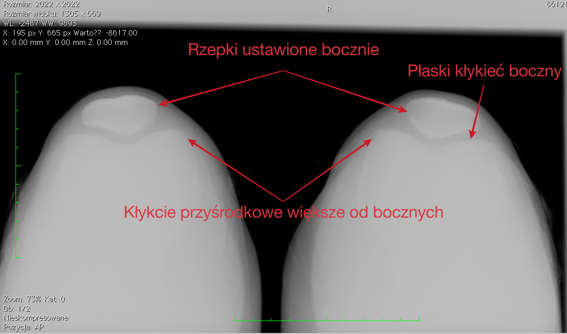 Zwichnięcie rzepki. Przyczyny urazu oraz jego leczenie. - Fizjologika Rzepka Typu 2 Wg Wiberga
